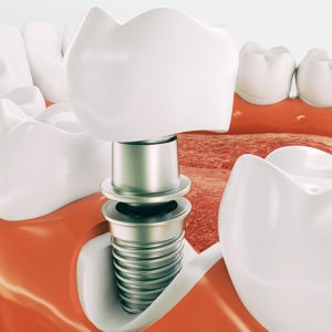 Die Zahnarztpraxis Dr. Bade in Rostock ist Ihr Spezialist wenn es um Zahnimplantate geht.